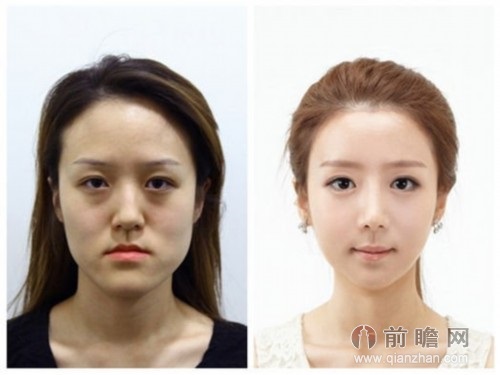 韩国双胞胎整容逆袭 变脸后依旧一模一样惊艳