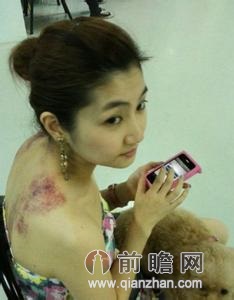 selina烧伤图片图片 selina烧伤图片图片大全 社会热点图片 高清图片