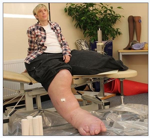 17,巨腿症?双腿过快生长