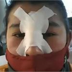 女子隆鼻失败成“牛魔王” 流血化脓惨不忍睹