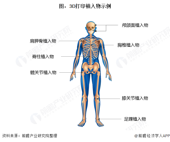 图：3D打印植入物示例