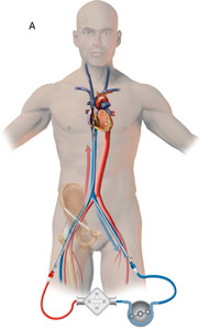 什么时候上呼吸机重症患者的救命稻草--ECMO：从科普讲起，再谈谈如何从中寻找临床研究思路_https://www.jmylbn.com_新闻资讯_第2张