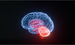 人工智能可帮助确定神经刺激的大脑区域，有望解决相关脑部疾病