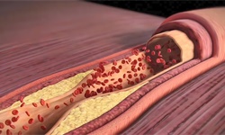 收藏！2023年全球心室辅助装置技术市场竞争格局分析 专利市场集中度有继续升高趋势