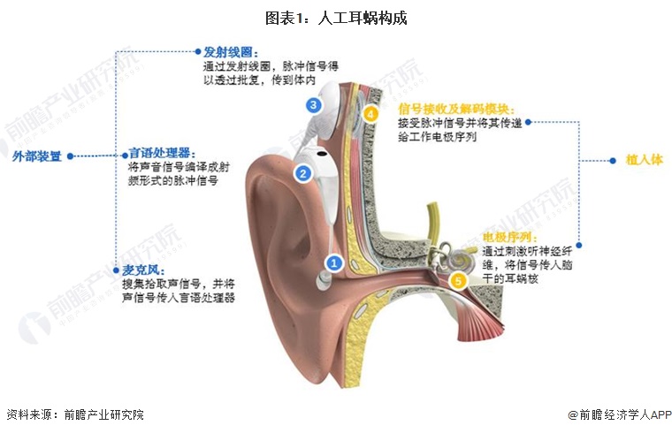 图表1：人工耳蜗构成